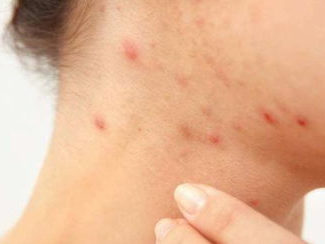 铁钉扎脚遗留隐患，20年后男子不幸患皮肤癌